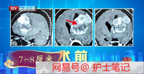 脑胶质瘤新纪元，重塑生活的自信与成就感的力量学习之路