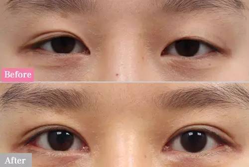 双眼皮最新技术揭秘，瞬间打造魅力电眼！