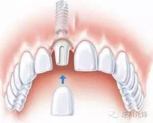 历史上的11月16日，种植牙降价最新消息全面解析与降价趋势展望