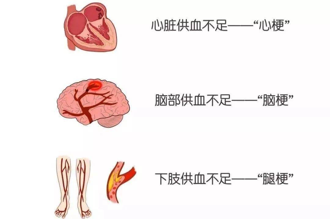 运动突发心梗演示：剧烈运动心肌梗塞是什么原因引起的 