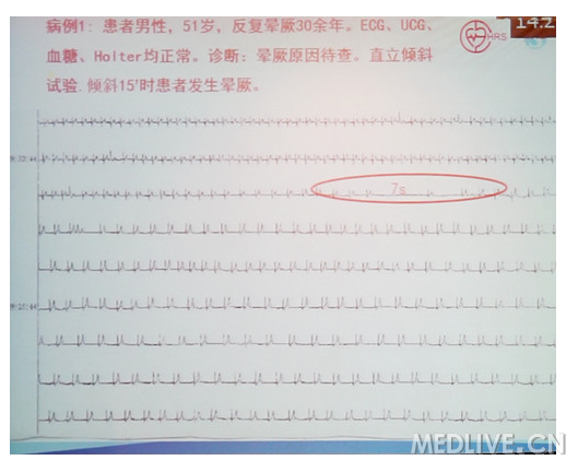 突发晕倒病例书写：突发晕厥现病史怎么写 