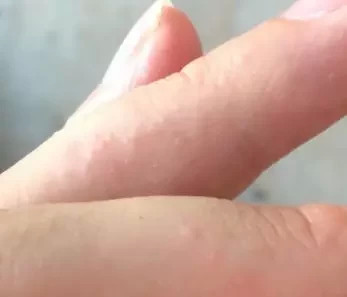 孩子身上突发小水泡痒：小孩身上起小水泡很痒 