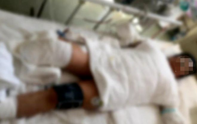 不断的截肢：截肢的含义 