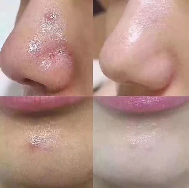 毛囊不断出油怎么回事：毛囊油腻怎么去除 