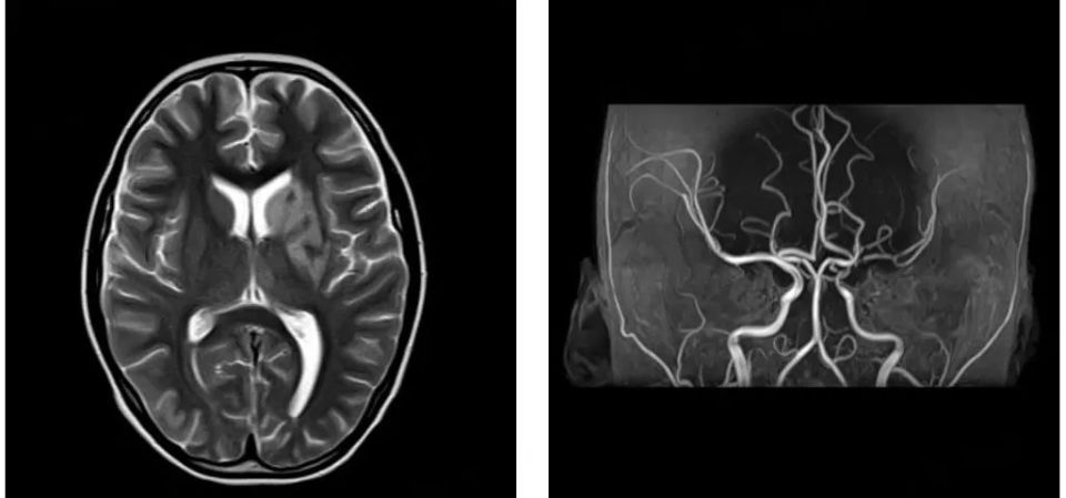 打球突发脑梗死：打球突然死亡 