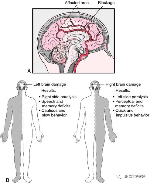 颅脑损伤康复护理规范：颅脑损伤的康复治疗ppt 