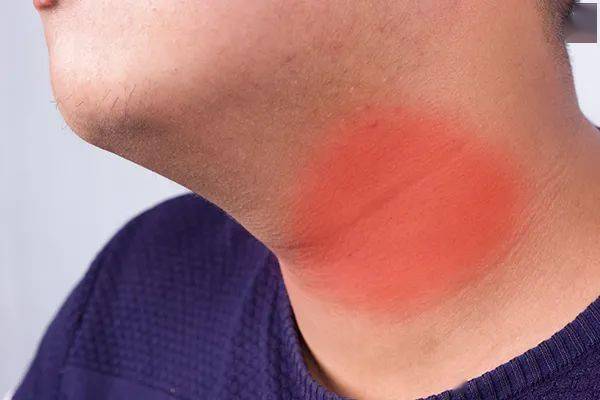 甲亢会不断出汗：甲亢会老出汗吗 