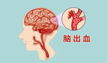 颅内出血，了解、应对与关怀之道