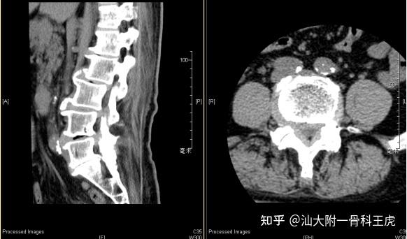 下肢突发软瘫的深入研究与解析