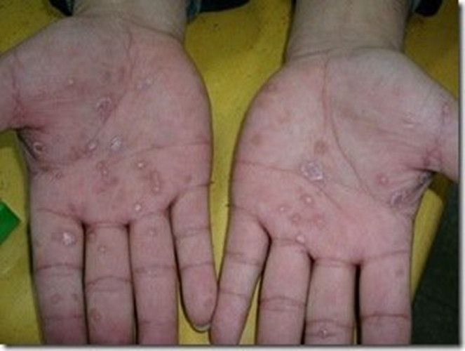 神梅突发疾病：神梅毒症状是什么 