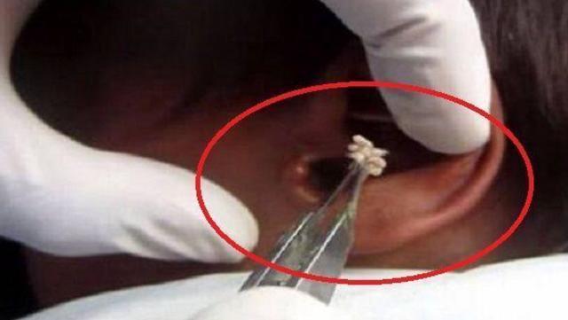 大人半夜突发耳朵疼痛：夜里突然耳朵疼 