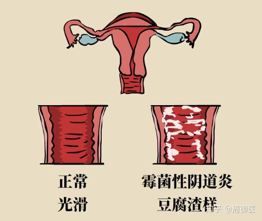 霉菌性阴道炎，全面解析与防治策略