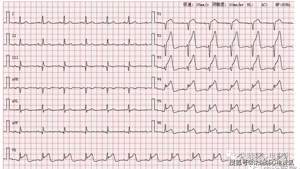 突发胸痛背后的心电图之谜,解析复杂情况下的健康危机