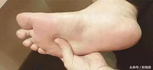 下肢浮肿原因、治疗与预防全解析，百度健康为您解答！