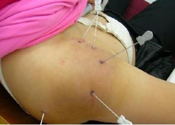 胸椎突发移位详解，原因、诊断及有效治疗方法