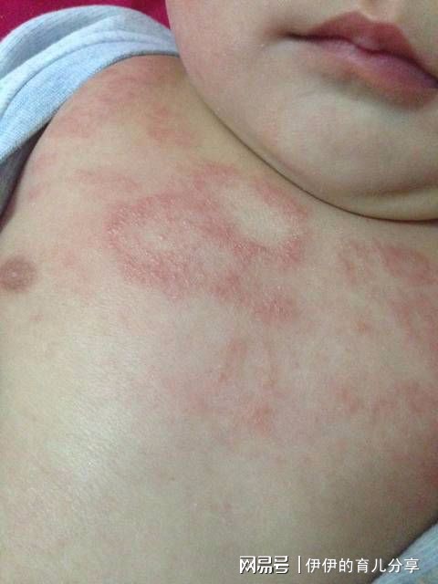 揭秘过敏真相，是突发疾病还是早有征兆？