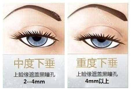 突发性单眼上睑下垂，全面解析原因、诊断与治疗