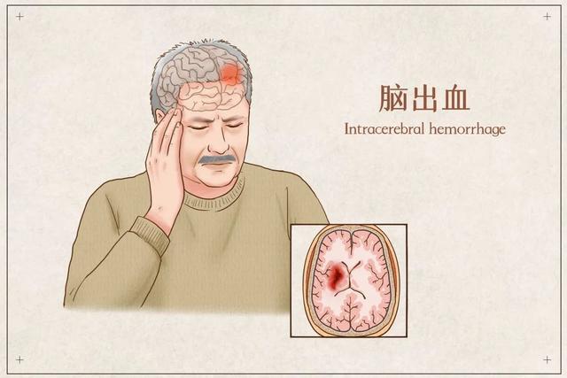 突发老年痴呆的原因深度解析,警惕这些潜在风险!